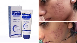 Aquasoft fc Advanced facial cream Review Malayalam / Indian pharmacy product for acne prone skin