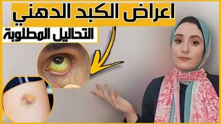 علامات بتحذرك من مشكلة في الكبد +التحاليل المطلوبة ( خطير وهام)