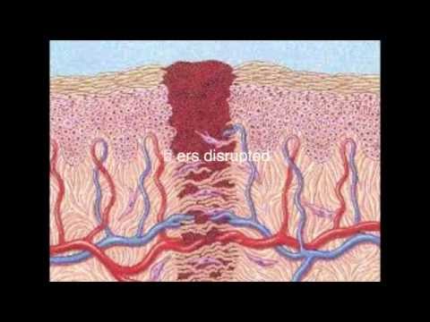 HOW TO GET RID OF ACNE SCARS NATURALLY HOW TO GET RID OF ACNE SCARS NATURALLY