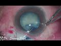 COMBINED CATARACT AND GLAUCOMA SURGERY - Dr. Saurav Piya