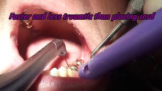 Dr. Miner demonstrates troughing with the laser around a tooth for a crown