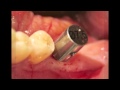 Dr. Jack Hahn, MD Guide Implant Spacing, Glidewell Hahn Implant Placement