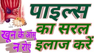 Haemorrhoids Treatment two Homeopathic Medicine || पाइल्स के लिए दो मेडिसिन