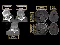 algorithmic multimodality approach to diagnosis and treatment of spinal csf leak