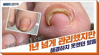 (Eng)유튜브보고 내성발톱 어머님 모시고 온 따님! (ft. 스케일링) l Fungal/Ingrown toenails [NP케어]