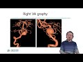 english treatment of intracranial vertebral artery dissections both ruptured and non ruptured