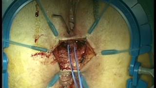 Modified Martius Graft  In Rectovaginal Fistula Repair After LAR For Rectal Cancer