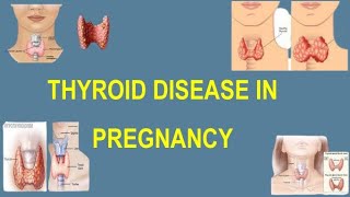 Thyroid Diseases in Pregnancy, Thyroid Dysfunction and Reproductive Health (TOG Article)