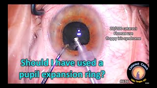 Quiz: Should I have used a pupil expansion ring in this cataract surgery?