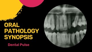 Dental Pulse | Oral Pathology Synopsis part 1 | Parry-Romberg Syndrome | Facial Hemiatrophy|NEET MDS