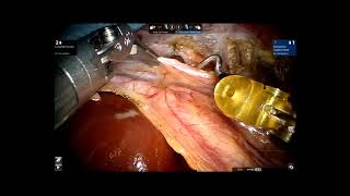 Robotic Laparoscopic Gastroesophageal Valvuloplasty Completely Unedited Video - F. Gharagozloo, M.D.