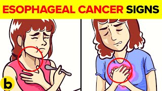 9 Warning Signs \u0026 Diagnosis Of Esophageal Cancer