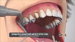 Dryz® Hemostatic Retraction Paste by Parkell Inc