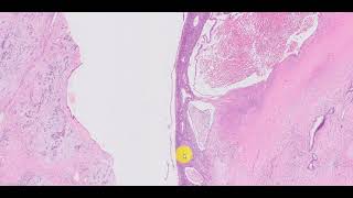 Mucinous cystic neoplasm pancreas