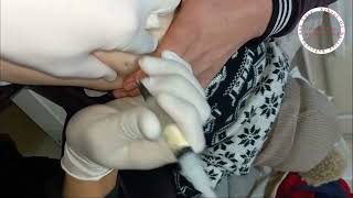 intramuscular injection buttock to child . A shot in the buttock. intramuscular injection technique