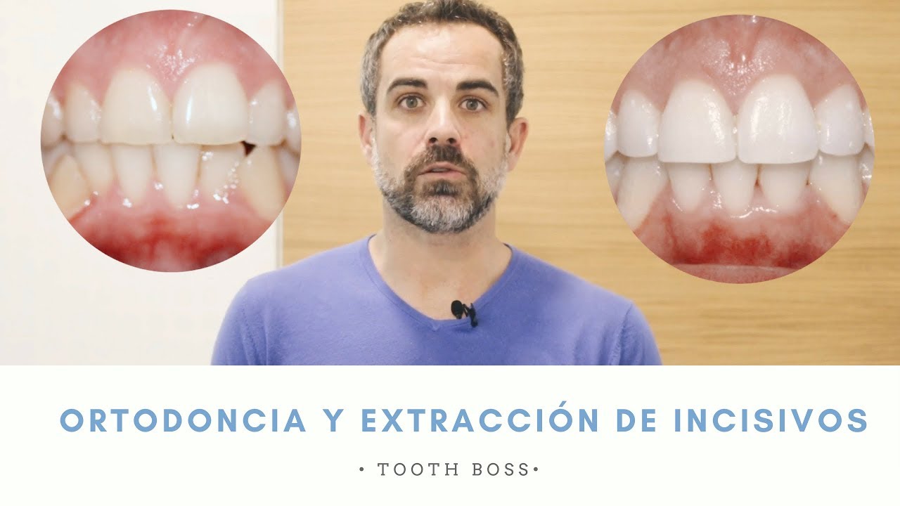 TOOTH BOSS || Ortodoncia Con Extracción De Incisivos || Ortodoncia En ...