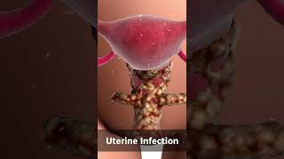 Uterine Infection | Best IVF Centre in Kanpur