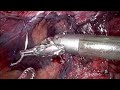 24 092 sliding inguinal bladder hernia a minimally invasive robotic assisted repair