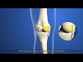 THUASNE Action Reliever Osteoarthritis patient video www.actionreliever.co.uk