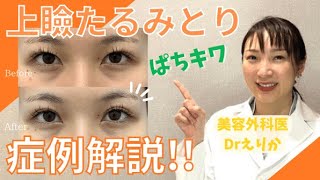 二重幅を取りも戻す！【ぱっちりキワ見せリフト】ぱちキワ症例解説！