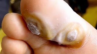 Fingers Of Feet Are Infected With Fungi  Be Careful To Trim The Wakes