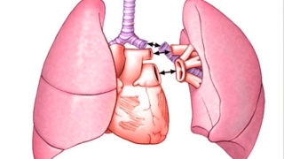 Idiopathic Pulmonary Fibrosis: Lung Transplants