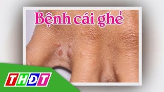 Tìm hiểu về Bệnh cái ghẻ | THDT