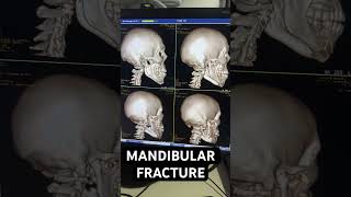 Mandibular fracture  @dr.rishika_surgeon #doctorslife #doctors #surgeryday #surgerysuccess