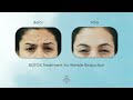 BOTOX Treatment for Wrinkle Reduction