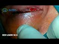 Eyelid tumor near Punctum by Dr Ben Limbu