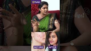 எனக்கு ரொம்ப Pimples இருக்கும் - Rachitha Mahalakshmi #pimpleproblem #skincare #actress #serial