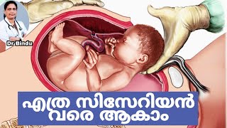 ഒരാൾക്ക് എത്ര സിസേറിയൻ വരെ ആകാം/How many safe cesarean section you can allow/Dr Bindu