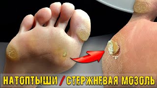 Педикюр СТОЛОВЫМИ ПРИБОРАМИ?! СТЕРЖНЕВАЯ МОЗОЛЬ 🤯 от ГВОЗДЯ . ГЛУБОКАЯ МОЗОЛЬ. ПЕДИКЮР.MASSIVE CORN