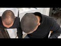 Hair Fiber Demonstration (DermMatch Hair Fibers vs Hair3)