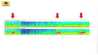 Quantitative EEG: Color Density Spectral Array (CDSA)