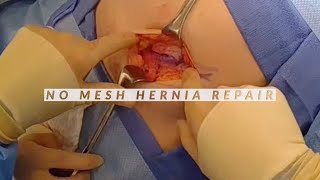 Dr Repta Performes a No Mesh Inguinal Hernia Repair with Previous Mesh Removal