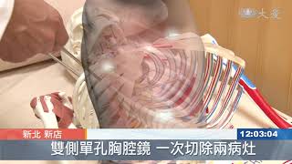 單孔胸腔鏡 左右肺癌一次切除