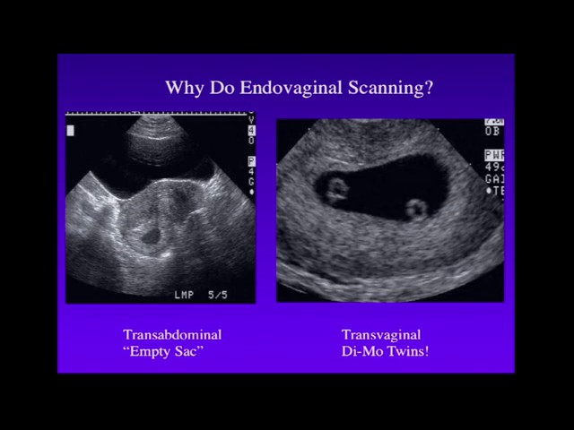Ultrasound Twins Pregnancy Update Week 8 Furnace Room Print Shop