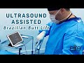 Ultrasound Assisted Brazilian Butt Lift