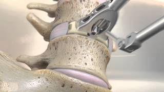 STALIF M™ (MIDLINE II) Surgical Technique Animation | Anterior Lumbar Interbody Fusion