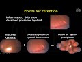 a2r season 1 35 posterior hyaloid precipitates