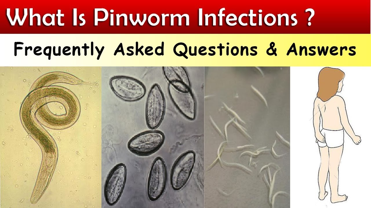 What Is Pinworm Infections ? ( FAQ & Answers ) - YouTube