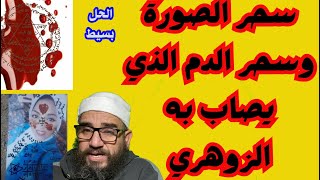 سحر الصورة وسحر الدم الذي يصاب به الزوهري الحل بسيط