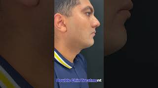 Double chin removal / fat dissolving