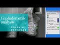 Dolphin cephalometric analysis - Orthodontic Matters Episode 16