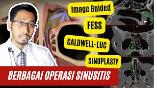 Sinusitis: Jenis jenis \u0026 Proses Operasi Sinusitis, Kenapa Diperlukan