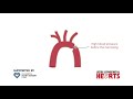 Coarctation of the Aorta