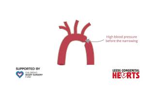 Coarctation of the Aorta