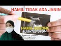 JANIN HILANG DALAM KANDUNGAN. PENYEBAB HAMIL KOSONG DAN PENCEGAHAN KEHAMILAN KOSONG