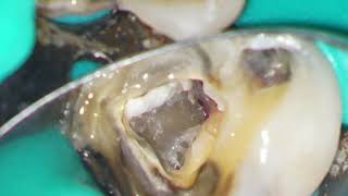 Managing Internal Resorption LR6